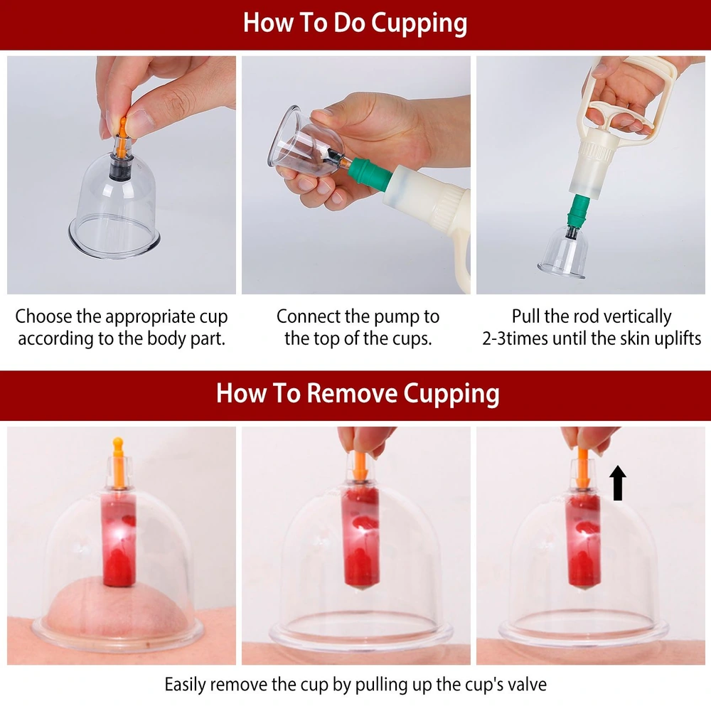 Instructional guide on how to perform and remove cupping therapy, featuring images of the cupping process, including cup selection, pump connection, and skin suction techniques.